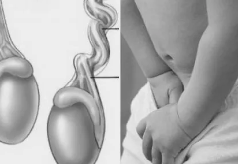 Cách nhận biết khối phồng ở vùng bẹn có thể là thoát vị bẹn